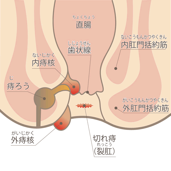 おしりによくある病気